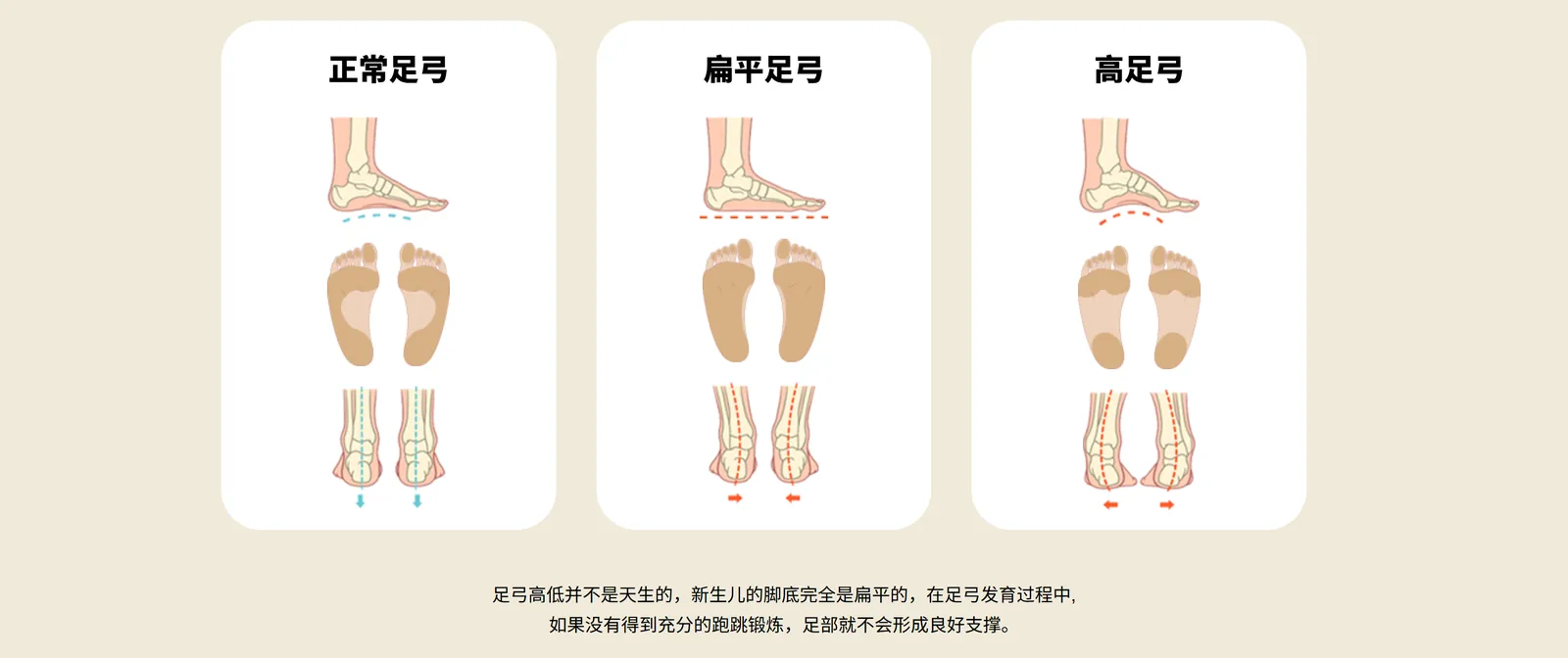 Normal, flat and high arch compared