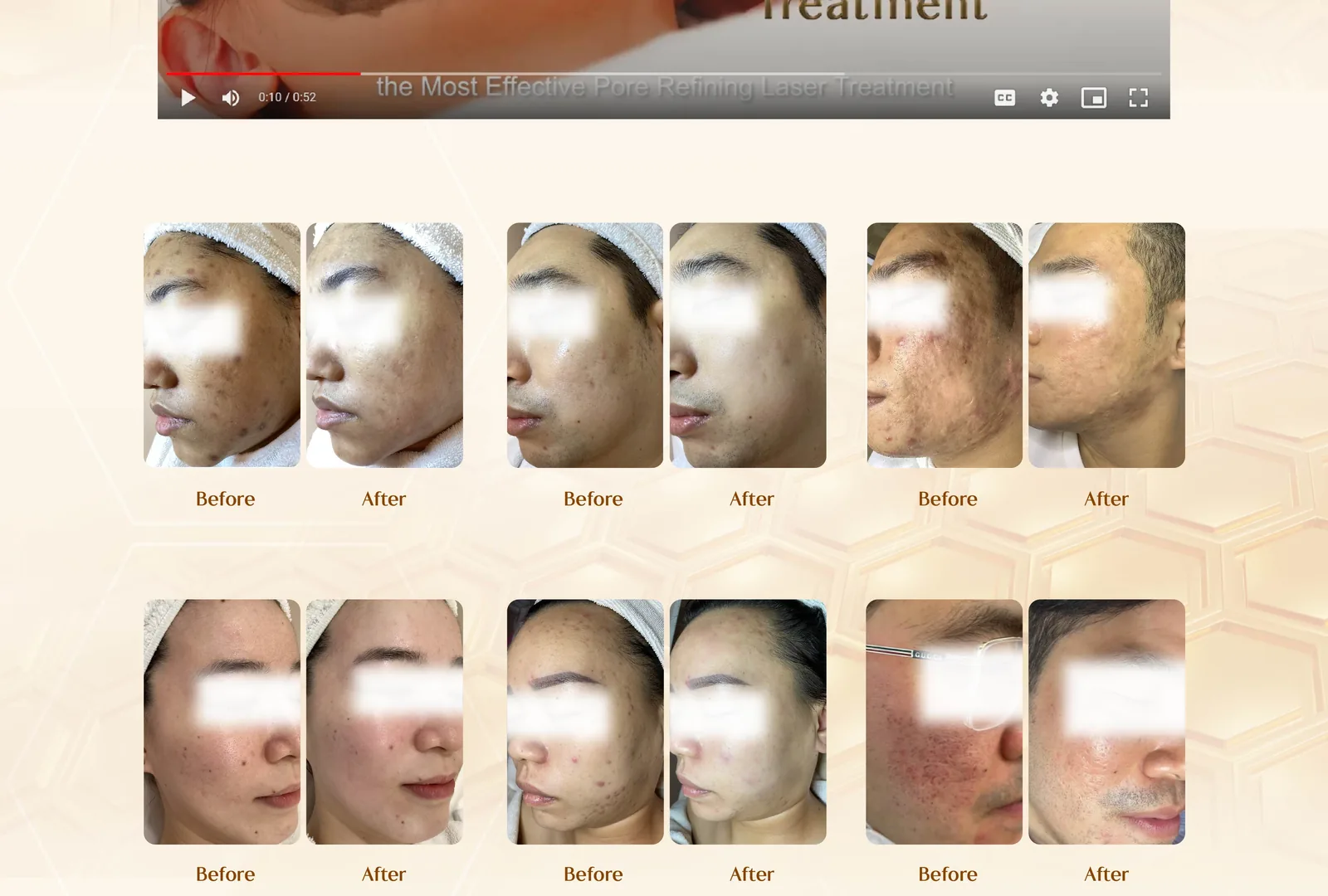 Before and after treatment results grid